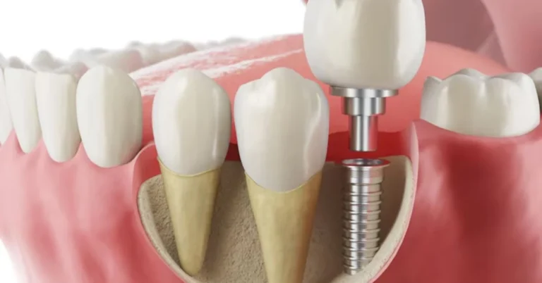 Dental Implants
