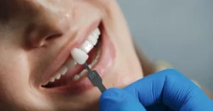 A ceramic teeth cap is a tooth-shaped covering made from ceramic materials that is placed over a damaged or decayed tooth.